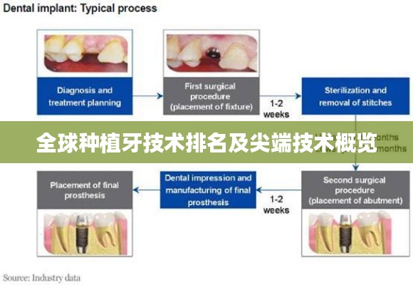 全球种植牙技术排名及尖端技术概览