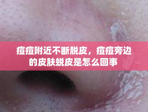 痘痘附近不断脱皮，痘痘旁边的皮肤蜕皮是怎么回事 