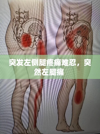 突发左侧腿疼痛难忍，突然左腿痛 